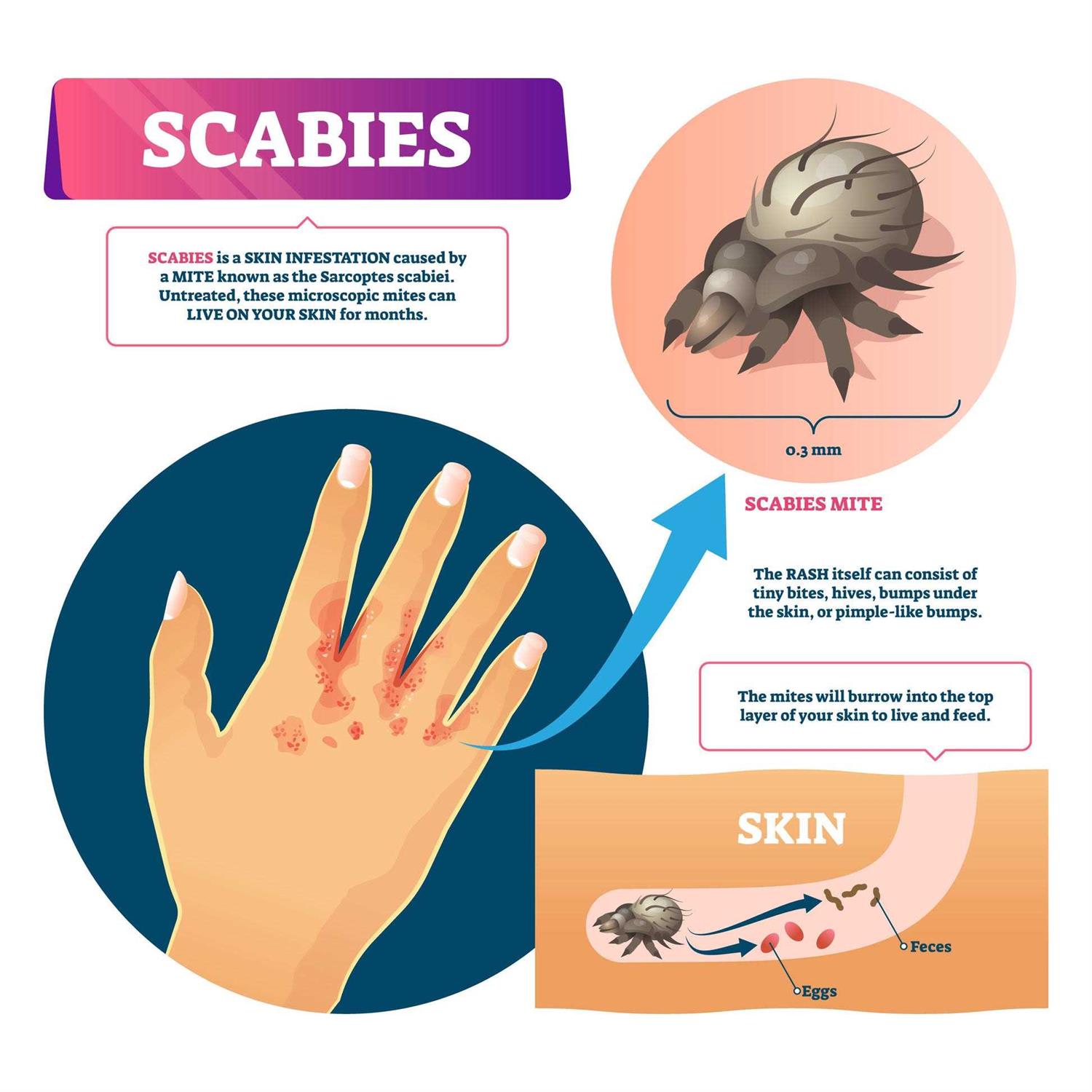 Alternative view of Naturasil Scabies Cream